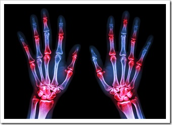 Rheumatoid Arthritis Solutions Quincy MA