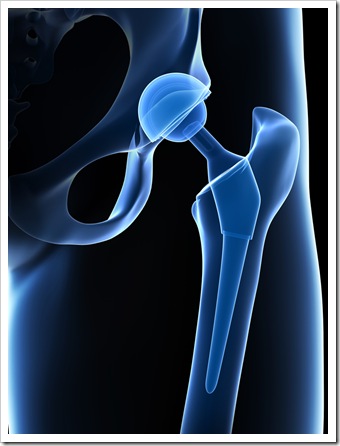 Back Pain Quincy MA Joint Replacement
