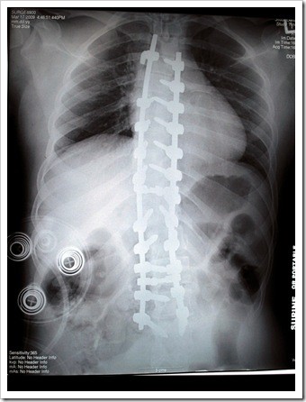 Quincy Scoliosis
