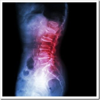 Back Pain Quincy MA Arthritis