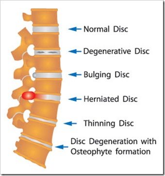 Quincy Back Pain