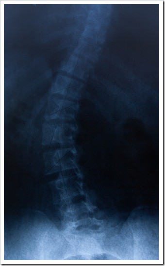 Quincy Scoliosis Treatment